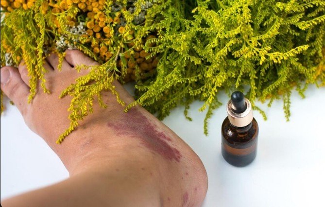 Are There Specific Remedies Used in Homeopathy to Heal Chronic Fissures?