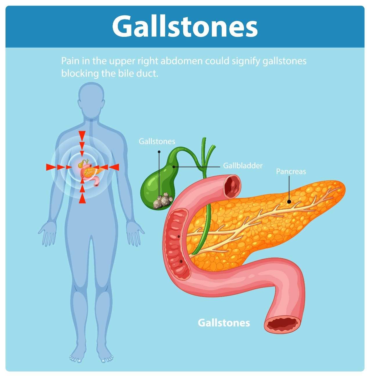 Gallbladder stone